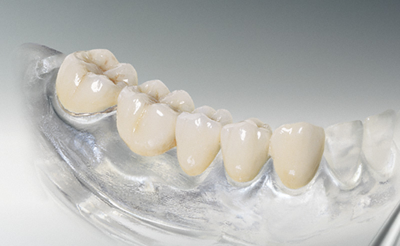 металлокерамические зубы