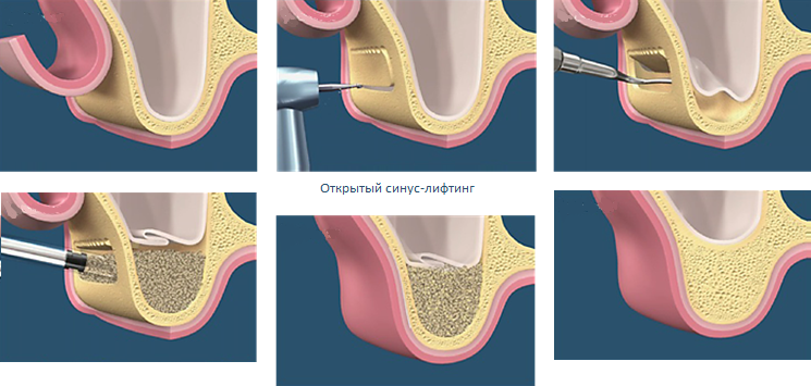 открытый синус-лифтинг