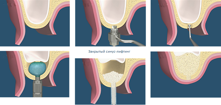 закрытый синус-лифтинг