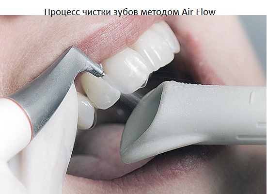 чистка зубов air flow