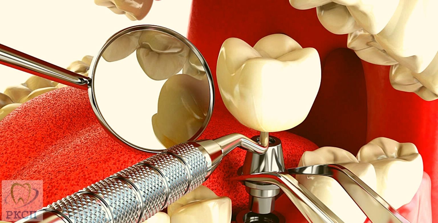 Имплантация – как доступная стоматологическая процедура