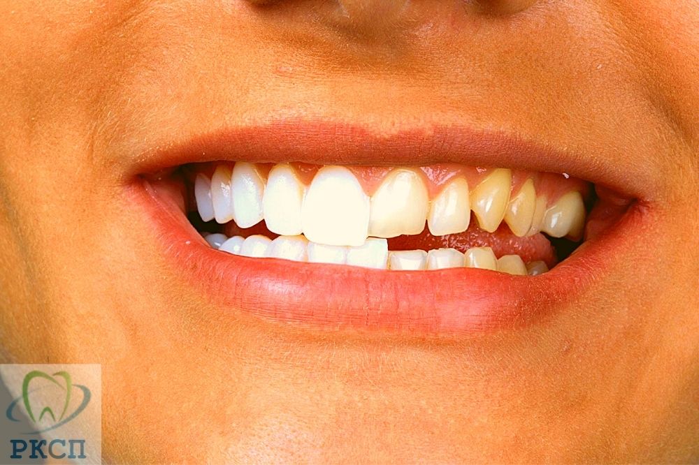 виниловые зубы