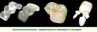 керамические вкладки