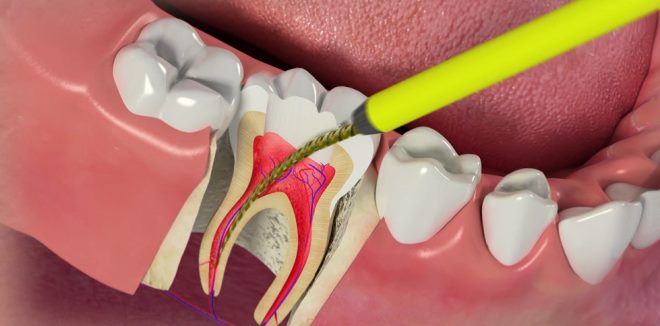 удаление зубных нервов