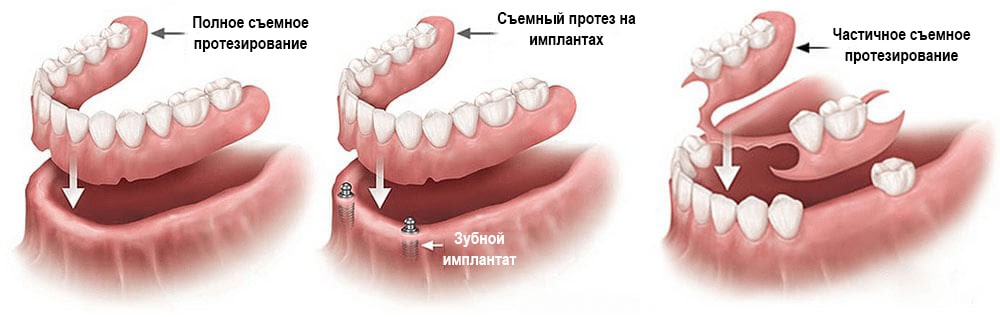 Виды съемного протезирования