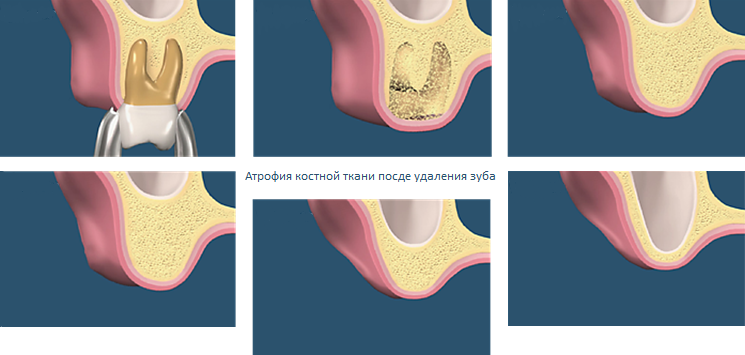 атрофия костной ткани