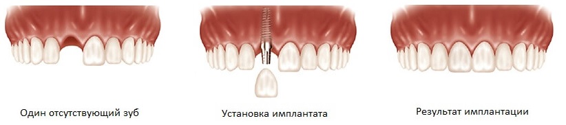 имплантация одного зуба в минске