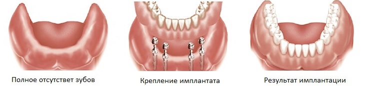 имплантация всех зубов в Минске