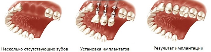 имплантация нескольких зубов в минске