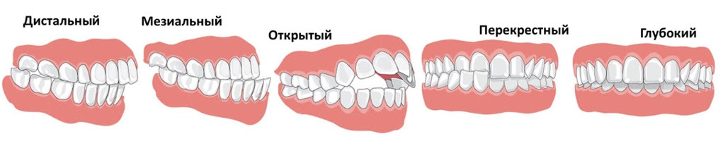 виды прикуса