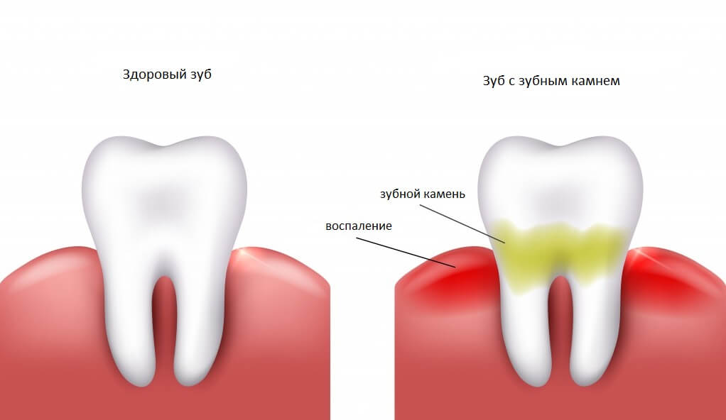 зубной камень