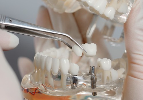 протезирование зубов в минске