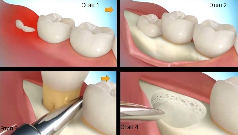 этапы удаления зуба мудрости
