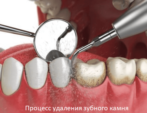 процесс удаления зубного камня